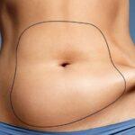 IS LIPOSUCTION GOOD FOR WOMEN?