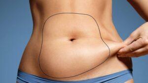 Read more about the article IS LIPOSUCTION GOOD FOR WOMEN?